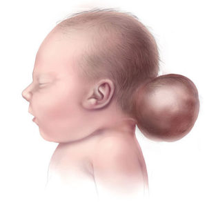 encephalocele
