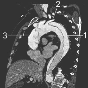 CT reconstruction of aortic dissection