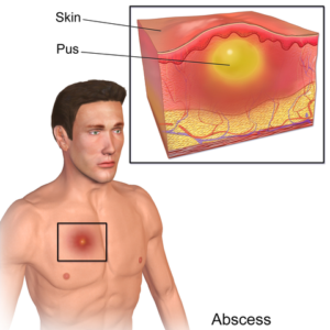 Abscess