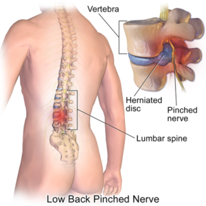 herniated lumbar disc