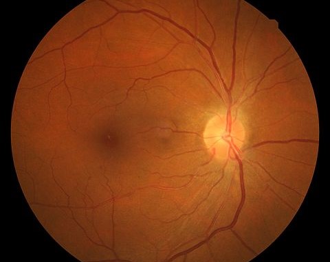 Hypertensive retinopathy