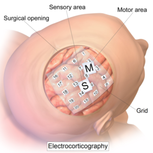 intracranial electrode grid for electrocorticography