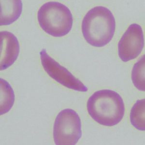 red blood cells in sickle cell disease