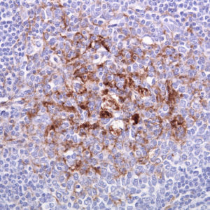 tonsil biopsy in variant CJD