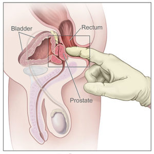 Digital-rectal-exam