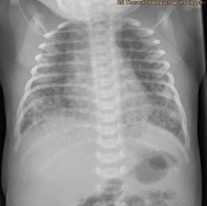 Chest X-ray of female neonate with meconium aspiration