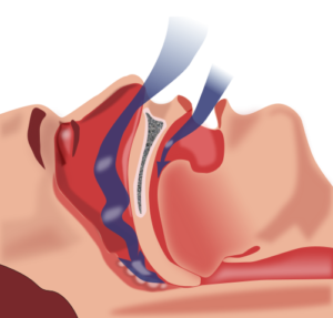 Illustration of obstruction of ventilation