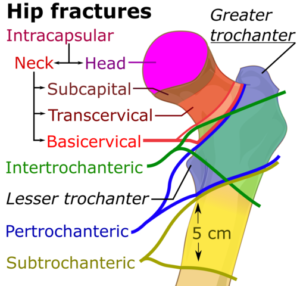 Hip_fracture_classification
