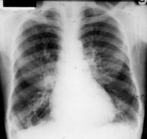 bronchiectasis imaging