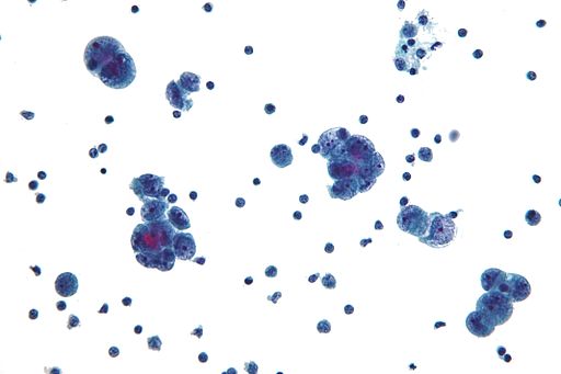Serous carcinoma cytology