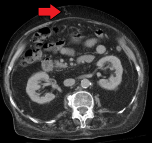 Portal hypertension