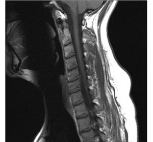 Cervical Spine MRI showing disc herniation