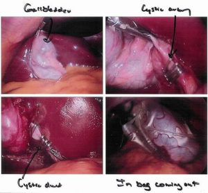 Cholecystectomy