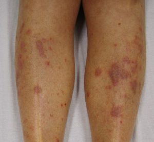 Lichen Planus