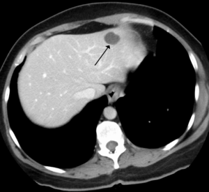 Liver-hemangioma-CT
