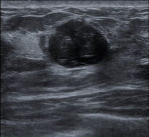 breast ultrasound image showing fibroadenoma
