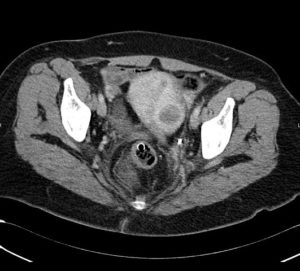 CT image of uterine fibroid