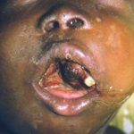 Picture of a mouth of a patient with Burkitt lymphoma showing disruption of teeth and partial obstruction of airway
