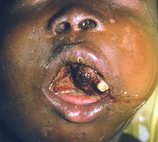 Picture of a mouth of a patient with Burkitt lymphoma showing disruption of teeth and partial obstruction of airway