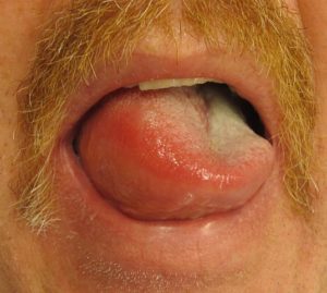 Angioedema of the tongue