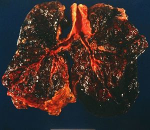pneumoconiosis