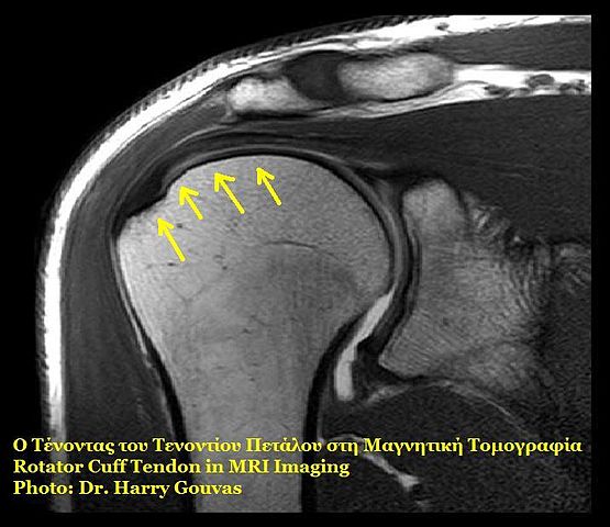 Rotator-cuff-MRI
