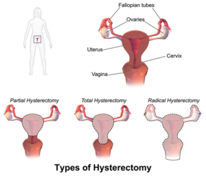 types of hysterectomy