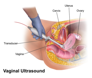 vaginal_ultrasound