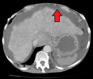Cirrhosis with ascites marked