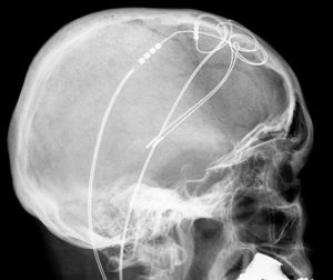 deep brain stimulation parkinson's disease