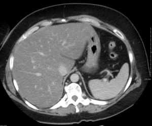 Liver steatosis (fatty liver disease) as seen on CT