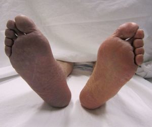 Arterial_thrombosis_causing_cyanosis