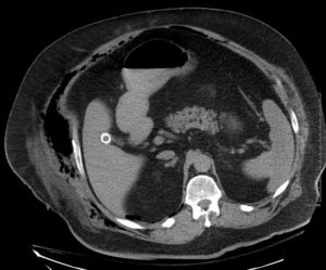 Necrotising fascitis producing gas in soft tissues