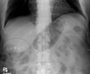 Gallstones as seen on plain x-ray.