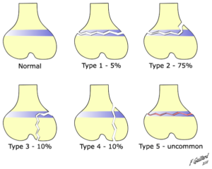 Salter-Harris-fracture-types