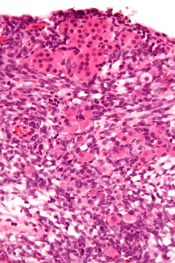sertoli-leydig cell tumor histopathology