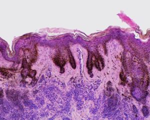 histopathology of solar lentigo