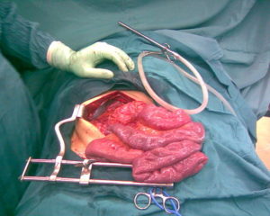 volvulus