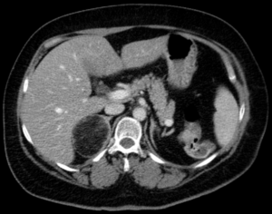 Myelolipom-rechts-CT-adrenal glands