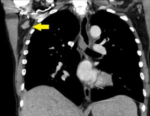 CT of axillary lymphadenopathy