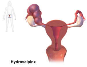 hydrosalpinx