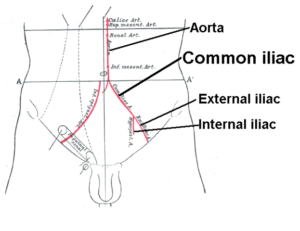 iliac artery bifurcation and aorta