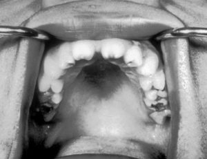 hutchinson teeth in congenital syphilis