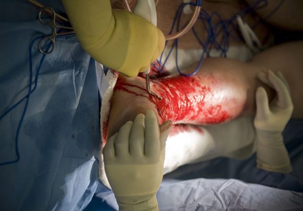 A burn victim undergoes surgery to remove skin from his legs that will be grafted over his burn