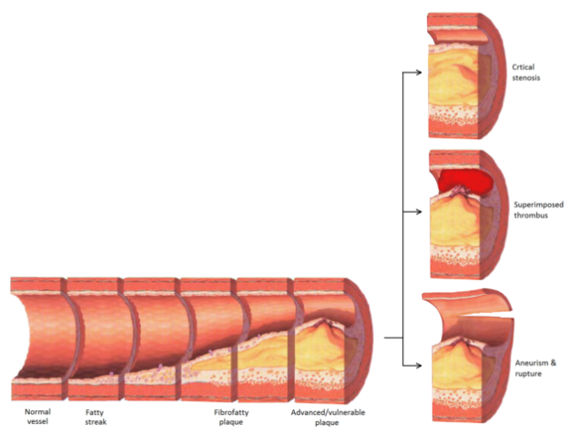 Late complications of atherosclerosis