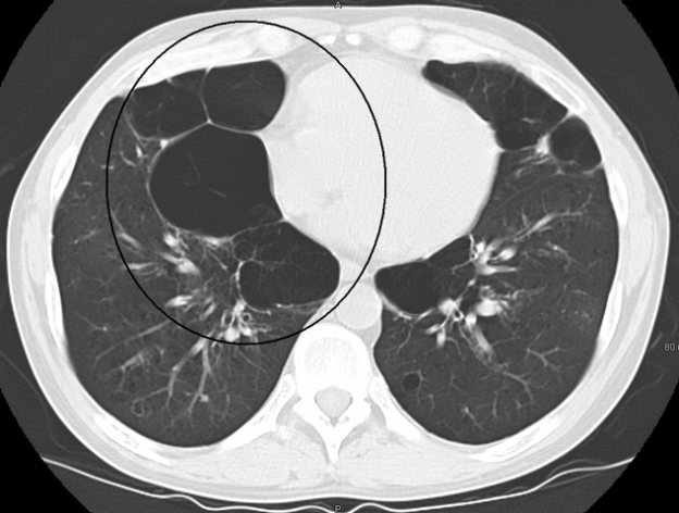 Radiographic Evaluation of Hyperinflated Lungs | Medical Library