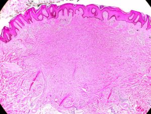 Dermatofibroma