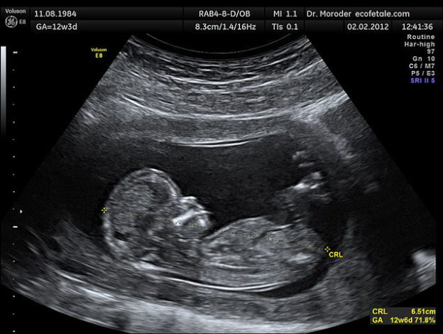 ultrasound-of-fetus-at-12-weeks
