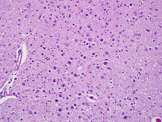 Polyglucosan_body_disease glycogen metabolism