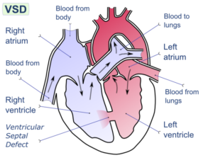 Ventricular-septal-defect-cardiac-diseases